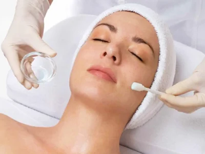 Chemical Peel2