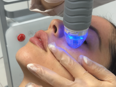 RF Microneedling